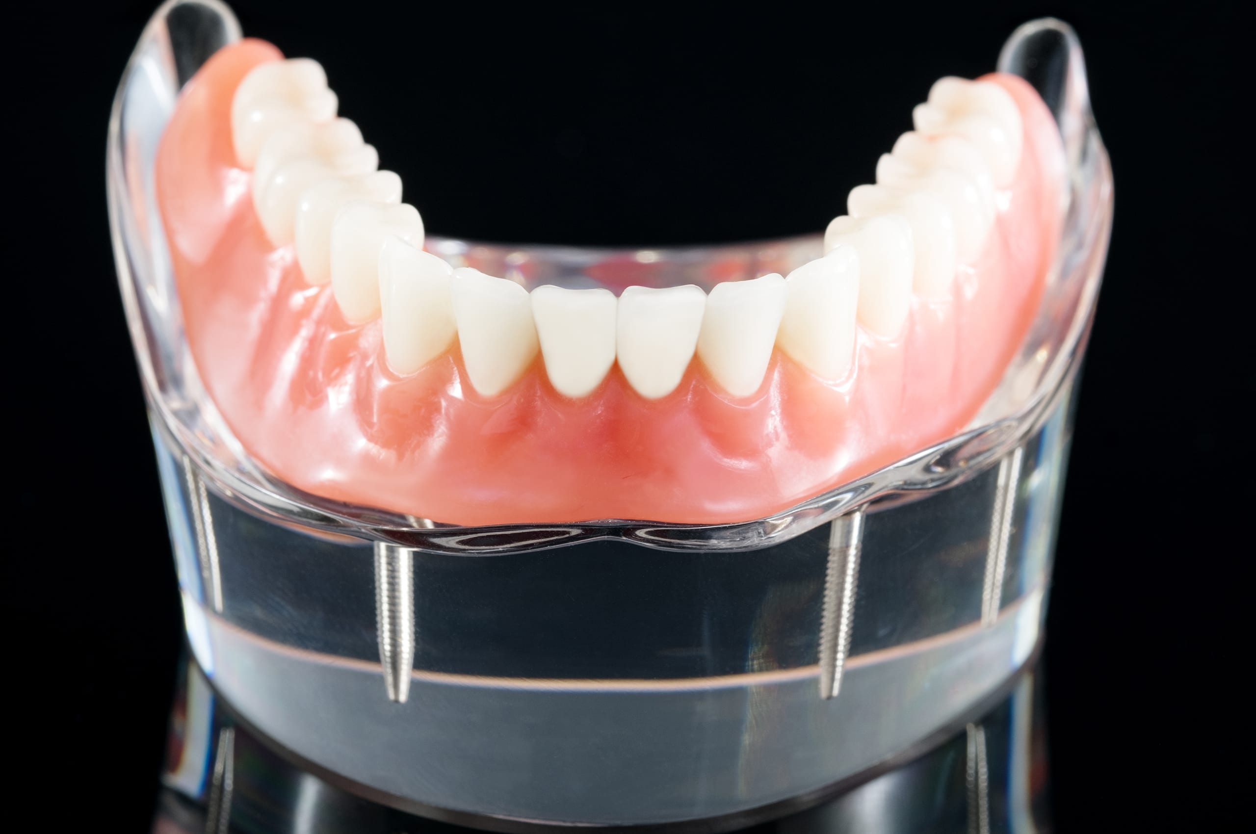 implant denture